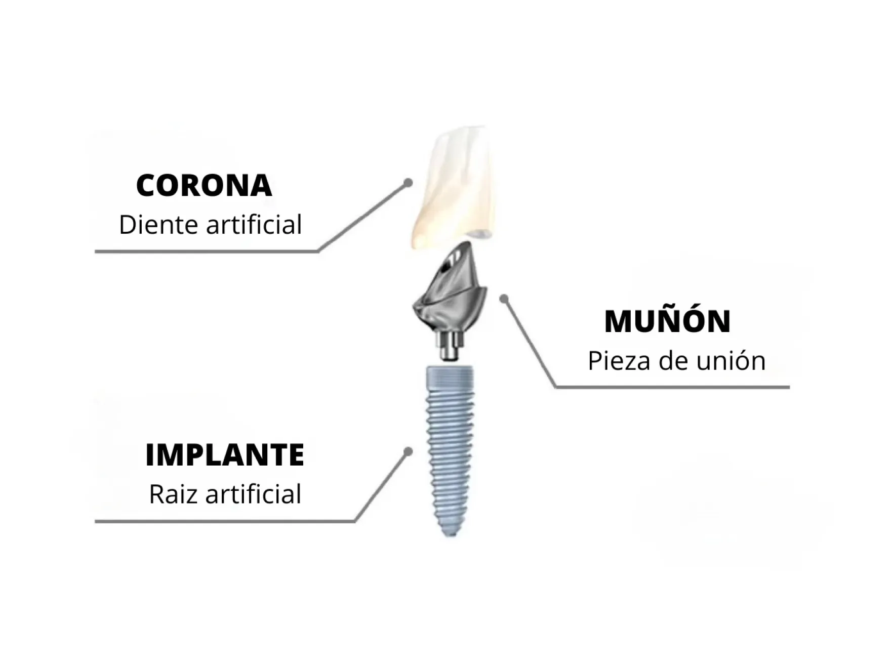 6552815baa22400118e9f446_dental-implants-04